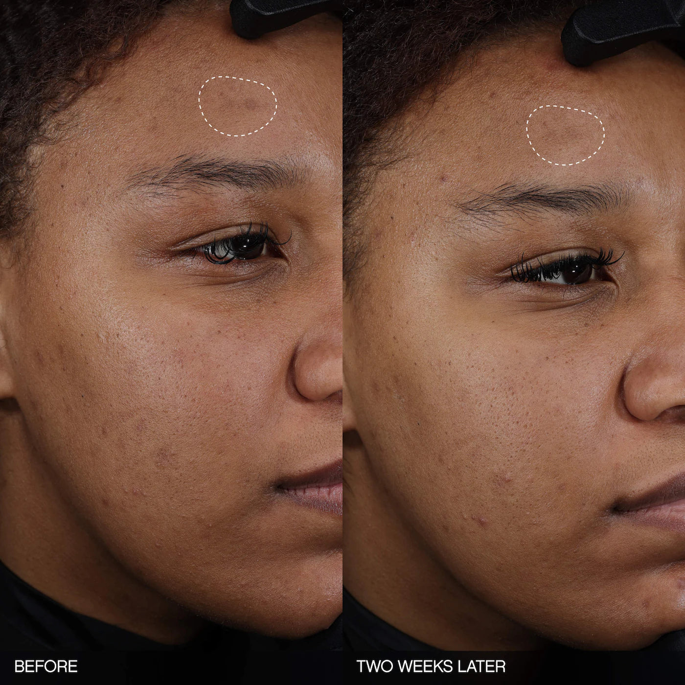 TOPICALS Faded Tranexamic Acid Dark Spot Patches for Hyperpigmentation *PRE ORDER*